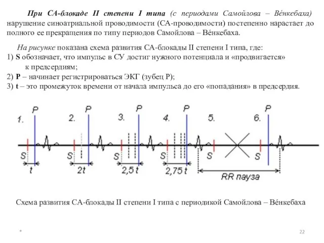 При СА-блокаде II степени I типа (с периодами Самойлова – Вéнкебаха)