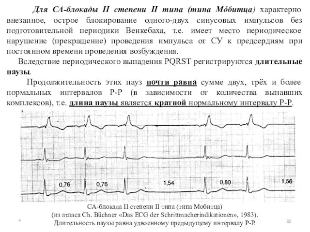 Для СА-блокады II степени II типа (типа Мóбитца) характерно внезапное, острое