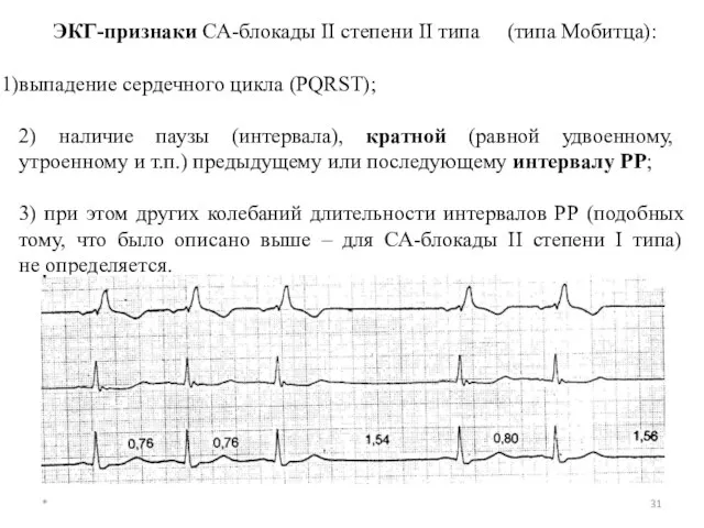 ЭКГ-признаки СА-блокады II степени II типа (типа Мобитца): выпадение сердечного цикла