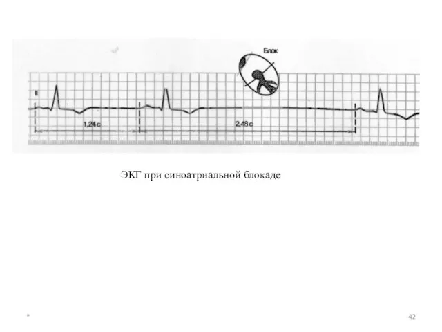* ЭКГ при синоатриальной блокаде