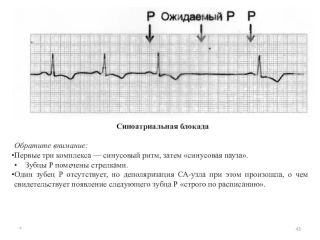 * Синоатриальная блокада Обратите внимание: Первые три комплекса — синусовый ритм,