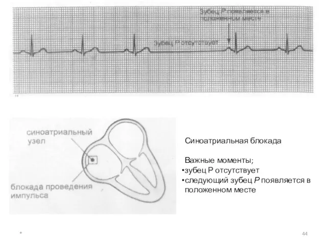 * Синоатриальная блокада Важные моменты; зубец Р отсутствует следующий зубец Р появляется в положенном месте