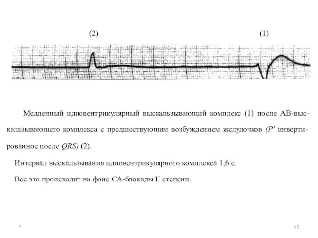 * Медленный идиовентрикулярный выскальзывающий комплекс (1) после АВ-выс-кальзывающего комплекса с предшествующим