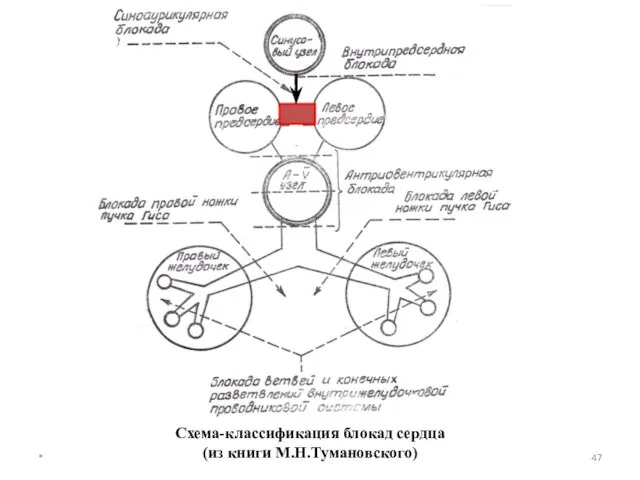 * Схема-классификация блокад сердца (из книги М.Н.Тумановского)