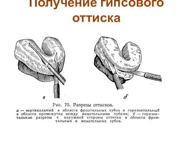 Получение гипсового оттиска