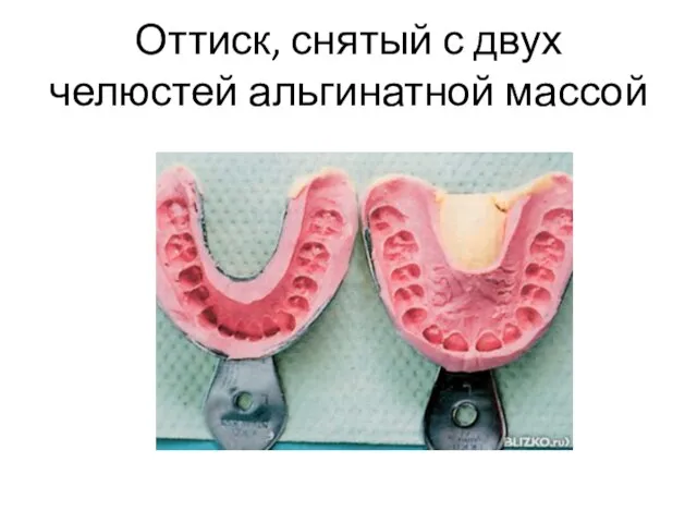 Оттиск, снятый с двух челюстей альгинатной массой