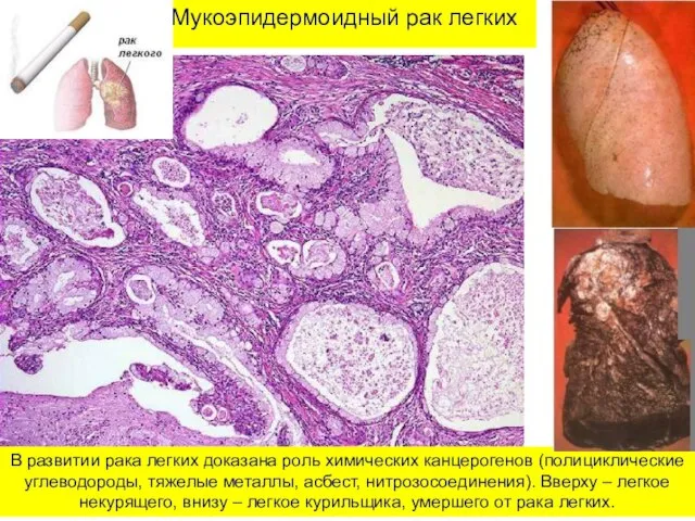 Мукоэпидермоидный рак легких В развитии рака легких доказана роль химических канцерогенов