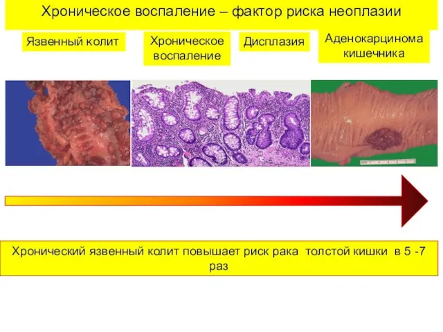 Хроническое воспаление – фактор риска неоплазии Язвенный колит Аденокарцинома кишечника Хроническое