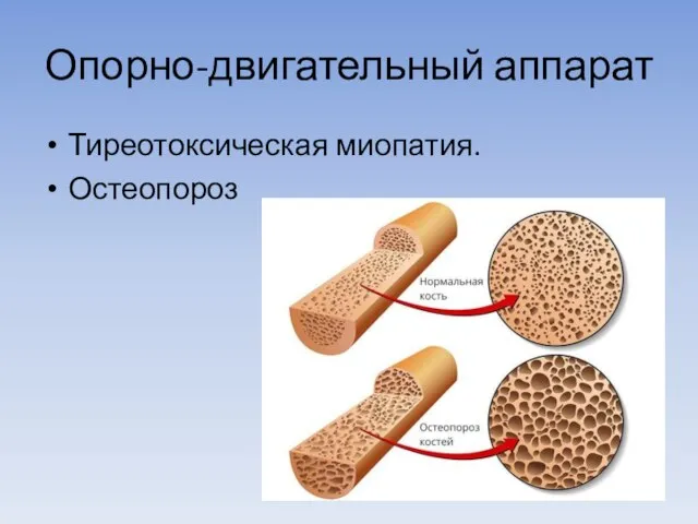 Опорно-двигательный аппарат Тиреотоксическая миопатия. Остеопороз