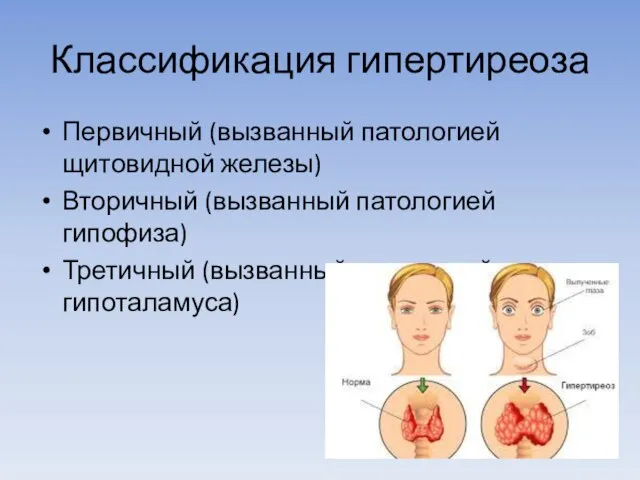 Классификация гипертиреоза Первичный (вызванный патологией щитовидной железы) Вторичный (вызванный патологией гипофиза) Третичный (вызванный патологией гипоталамуса)