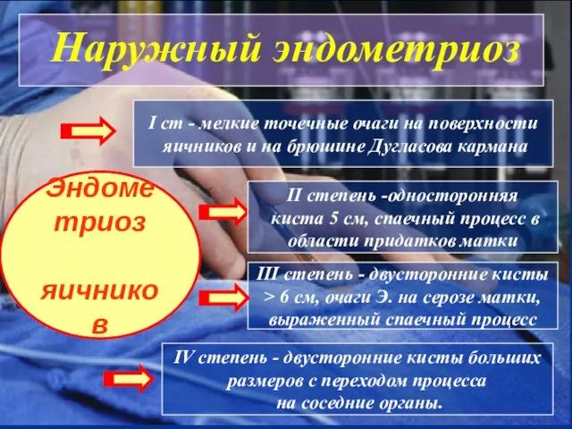 Наружный эндометриоз Эндометриоз яичников I ст - мелкие точечные очаги на