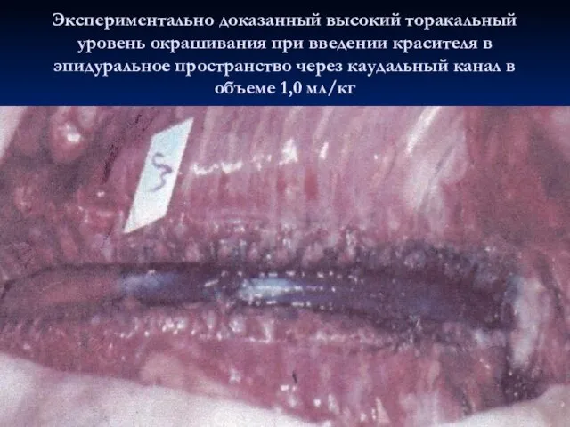 Экспериментально доказанный высокий торакальный уровень окрашивания при введении красителя в эпидуральное