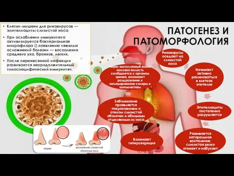 ПАТОГЕНЕЗ И ПАТОМОРФОЛОГИЯ Клетки-мишени для риновирусов — эпителиоциты слизистой носа. При