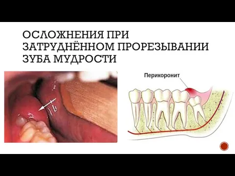 ОСЛОЖНЕНИЯ ПРИ ЗАТРУДНЁННОМ ПРОРЕЗЫВАНИИ ЗУБА МУДРОСТИ