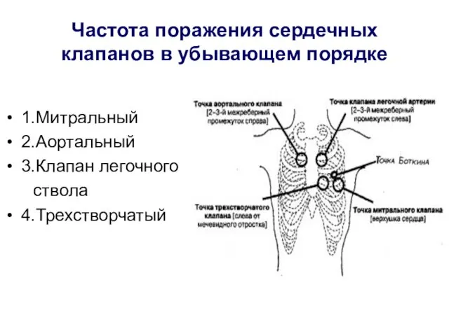 Частота поражения сердечных клапанов в убывающем порядке 1.Митральный 2.Аортальный 3.Клапан легочного ствола 4.Трехстворчатый