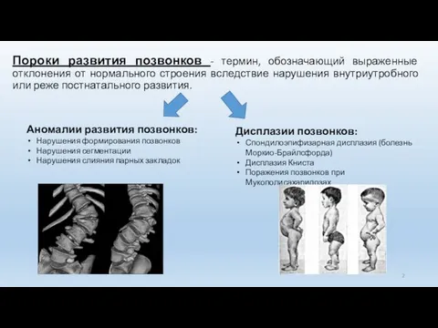 Пороки развития позвонков - термин, обозначающий выраженные отклонения от нормального строения