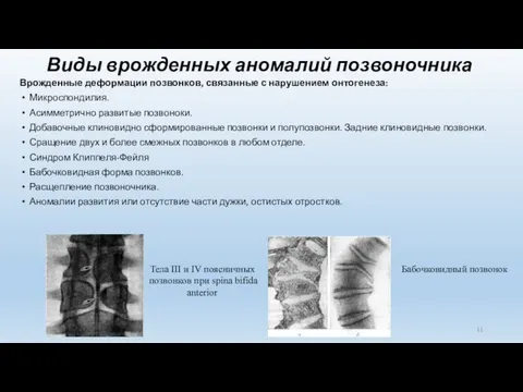 Виды врожденных аномалий позвоночника Врожденные деформации позвонков, связанные с нарушением онтогенеза: