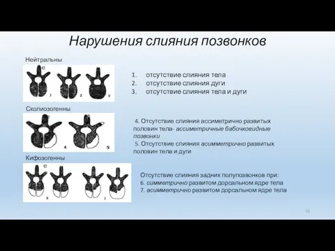 Нарушения слияния позвонков Нейтральные отсутствие слияния тела отсутствие слияния дуги отсутствие