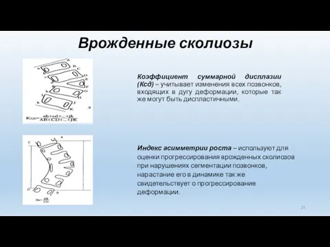 Врожденные сколиозы Коэффициент суммарной дисплазии (Ксд) – учитывает изменения всех позвонков,