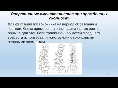 Оперативные вмешательства при врожденных сколиозах Для фиксации позвоночника на период образования