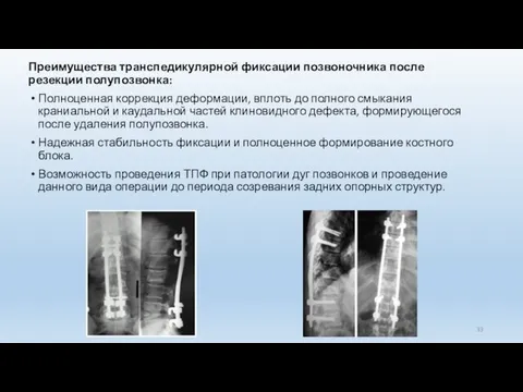 Преимущества транспедикулярной фиксации позвоночника после резекции полупозвонка: Полноценная коррекция деформации, вплоть