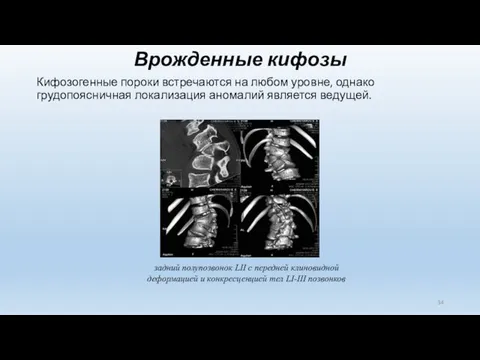 Врожденные кифозы Кифозогенные пороки встречаются на любом уровне, однако грудопоясничная локализация