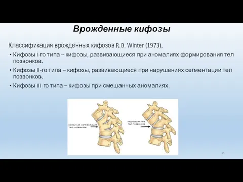 Врожденные кифозы Классификация врожденных кифозов R.B. Winter (1973). Кифозы I-го типа