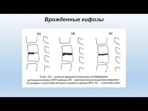 Врожденные кифозы