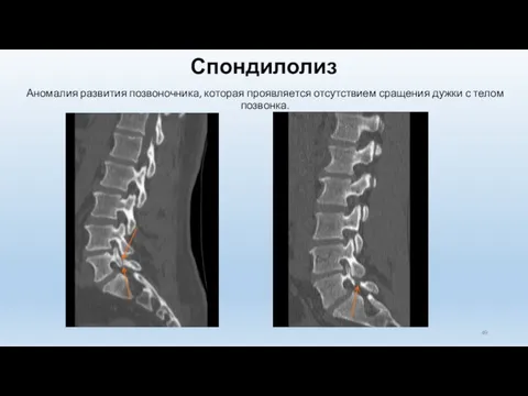 Спондилолиз Аномалия развития позвоночника, которая проявляется отсутствием сращения дужки с телом позвонка.