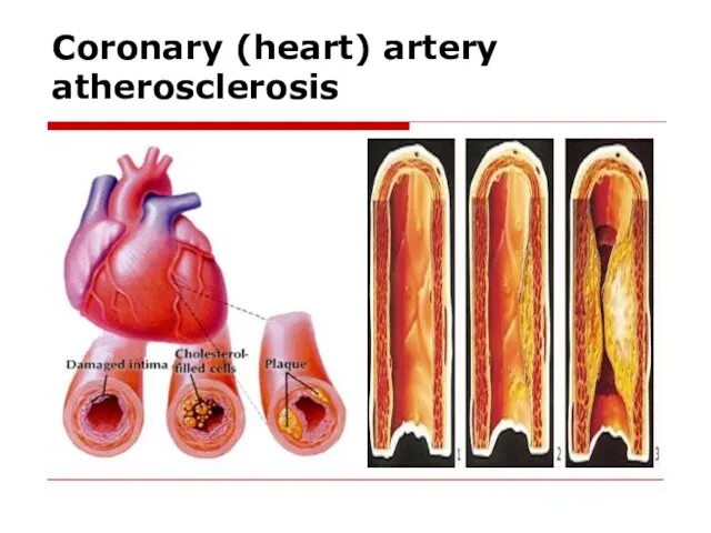 Coronary (heart) artery atherosclerosis