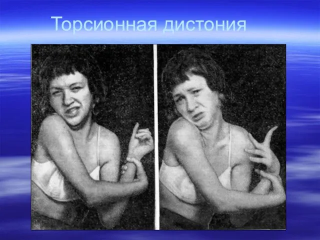 Торсионная дистония