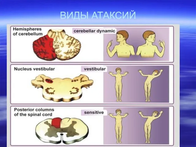 ВИДЫ АТАКСИЙ