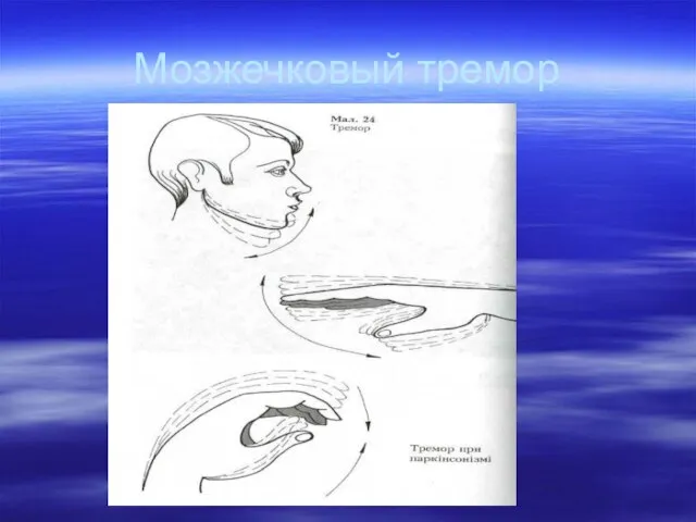 Мозжечковый тремор