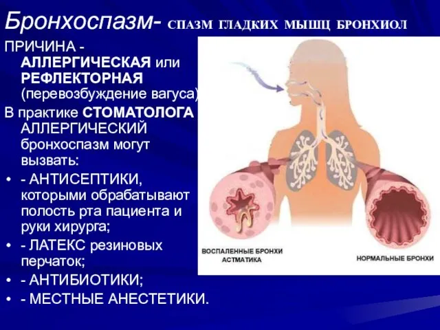 Бронхоспазм- СПАЗМ ГЛАДКИХ МЫШЦ БРОНХИОЛ ПРИЧИНА - АЛЛЕРГИЧЕСКАЯ или РЕФЛЕКТОРНАЯ (перевозбуждение