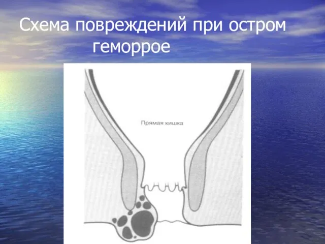 Схема повреждений при остром геморрое