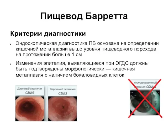 Пищевод Барретта Критерии диагностики Эндоскопическая диагностика ПБ основана на определении кишечной