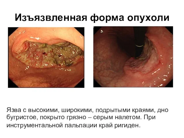 Изъязвленная форма опухоли Язва с высокими, широкими, подрытыми краями, дно бугристое,