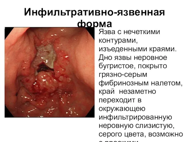 Инфильтративно-язвенная форма Язва с нечеткими контурами, изъеденными краями. Дно язвы неровное