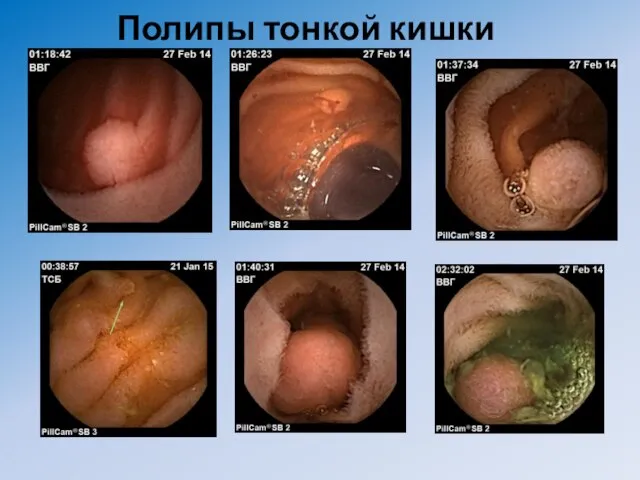 Полипы тонкой кишки