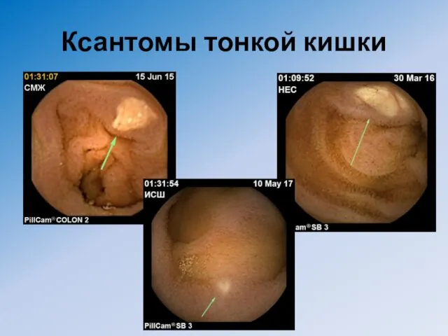 Ксантомы тонкой кишки