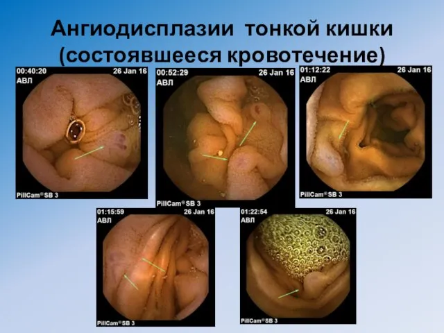 Ангиодисплазии тонкой кишки (состоявшееся кровотечение)