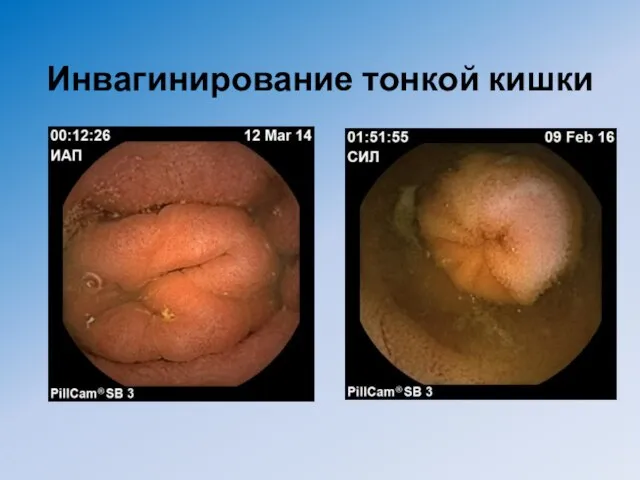 Инвагинирование тонкой кишки