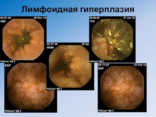 Лимфоидная гиперплазия