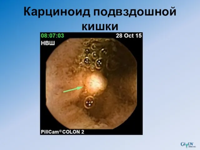 Карциноид подвздошной кишки