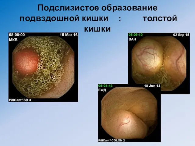 Подслизистое образование подвздошной кишки : толстой кишки