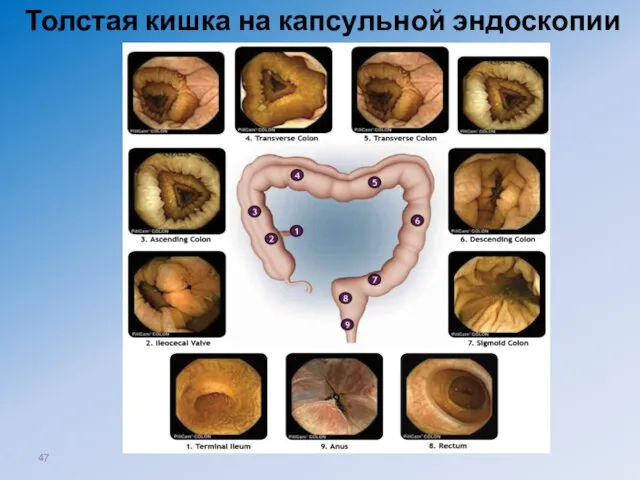 Толстая кишка на капсульной эндоскопии