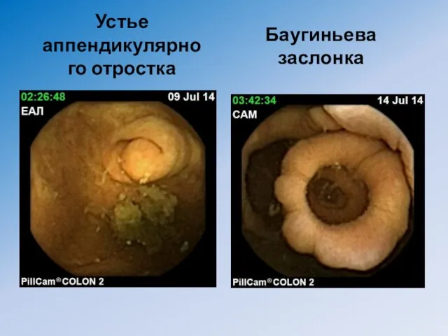 Устье аппендикулярного отростка Баугиньева заслонка