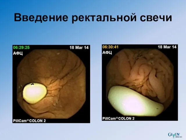 Введение ректальной свечи