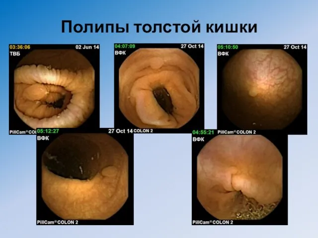 Полипы толстой кишки