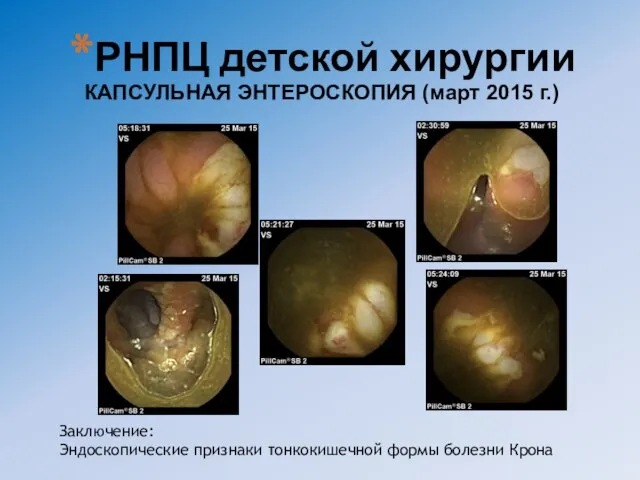 Заключение: Эндоскопические признаки тонкокишечной формы болезни Крона РНПЦ детской хирургии КАПСУЛЬНАЯ ЭНТЕРОСКОПИЯ (март 2015 г.)